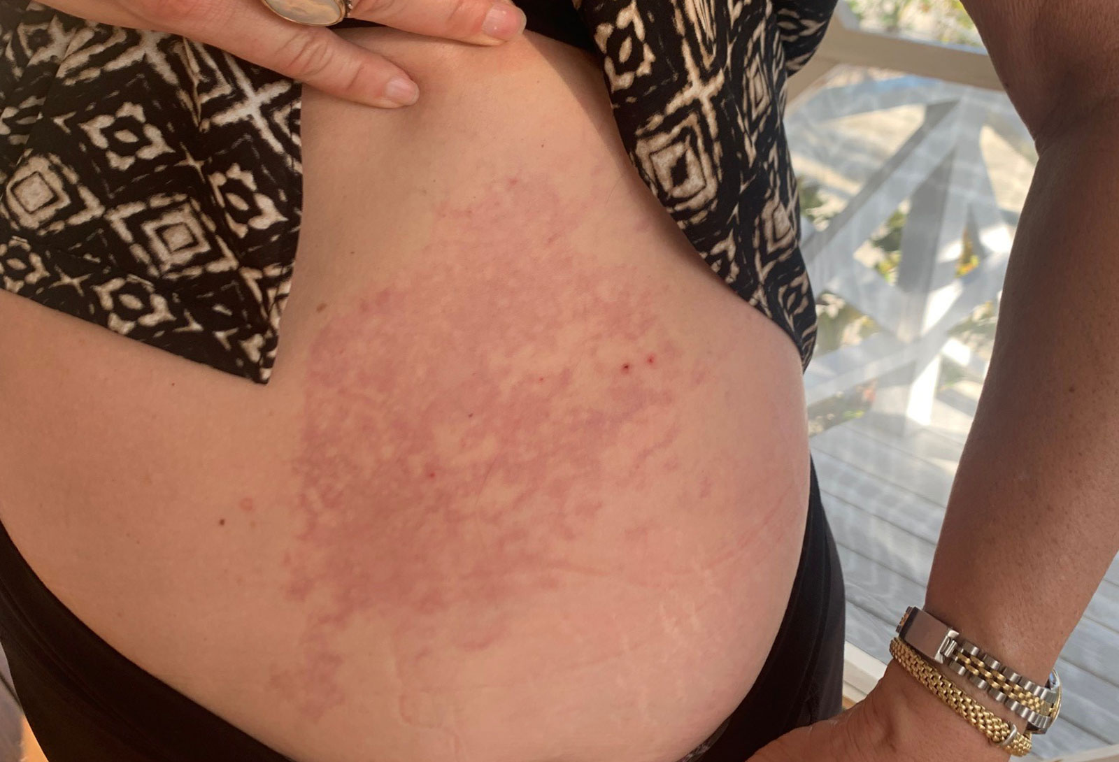 an-example-of-skin-bends